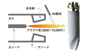 インプラント器具