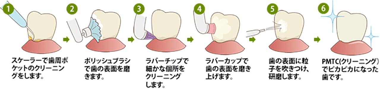 PMTCの手順