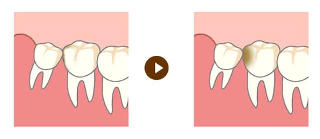 親知らずが少し出ている場合