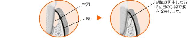 親知らずが歯茎の中に埋没している場合