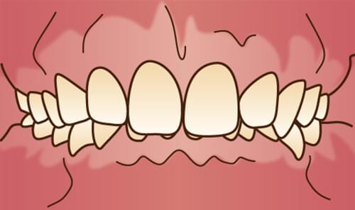 前歯の噛み合わせが深い。